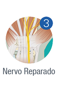 nervo-reparado